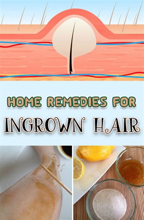 17_home-remedies-for-ingrown-hair | Ingrown hair, Ingrown hair remedies ...