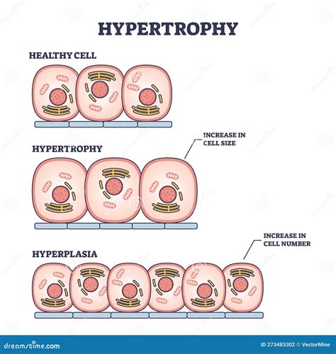 Hypertrophy, Hyperplasia or Healthy Muscular Cells Comparison Outline ...