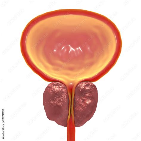 Benign prostatic hyperplasia, 3D illustration showing enlarged prostate gland Stock Illustration ...