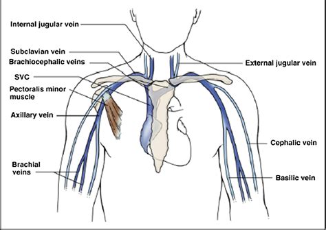 Upper-extremity Deep Venous Thrombosis: A Review - The American Journal ...