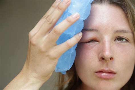 Swollen Eyelids: Causes &amp; Treatment | MyVision.org