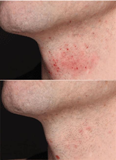 Reducing Redness and Razor Burn in Shaving Applications | Cosmetics ...