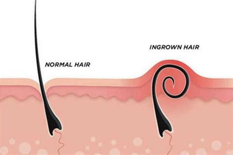 How To Heal A Ingrown Hair - Swimmingkey13
