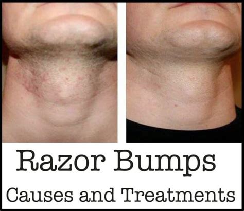 Razor Bumps, Causes and Treatments