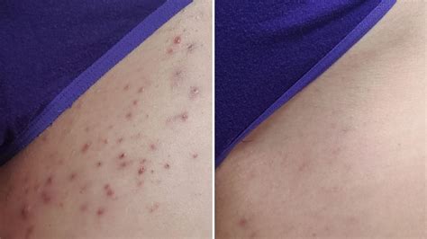 Razor Burn Photos - Library of Close Up Images – Bushbalm