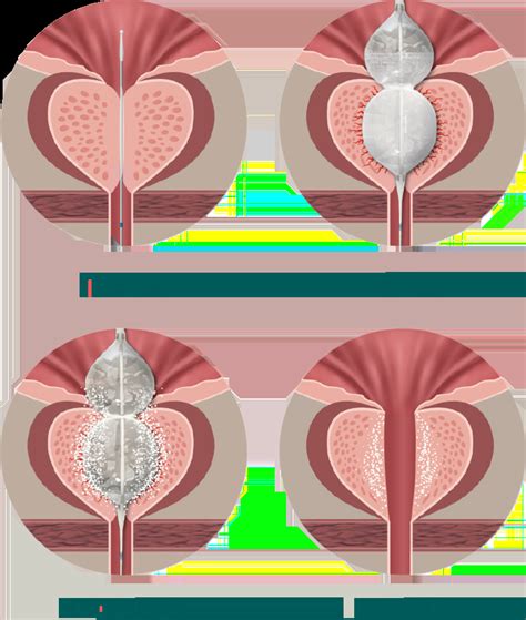 Benign Prostatic Hyperplasia (BPH) - Laborie