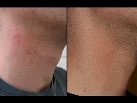 How to avoid neck shave irritation & razor bumps?