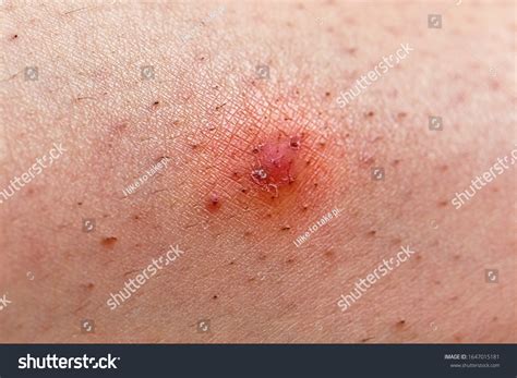 Closeup Caucasian Skin Ingrown Hair Stock Photo 1647015181 | Shutterstock