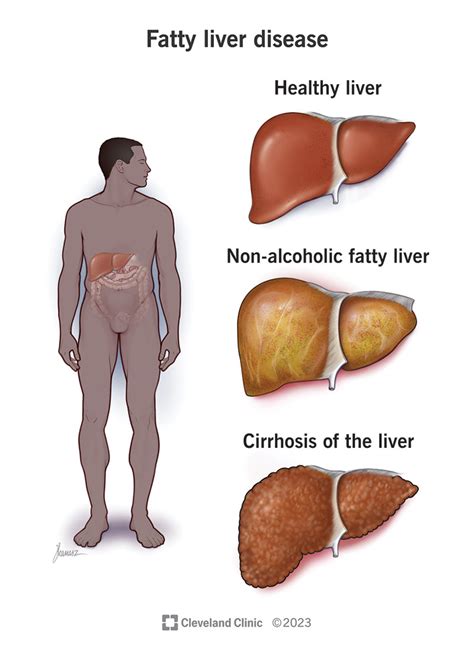 Cirrhosis