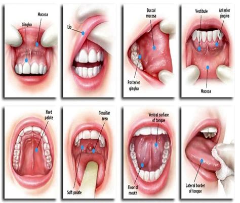 ORAL CANCER : Mouth Cancer Screening - Cancer Prevention