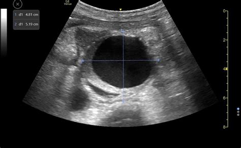 Point-of-Care Ultrasound for Identification of Ruptured Infrarenal Abdominal Aortic Aneurysm