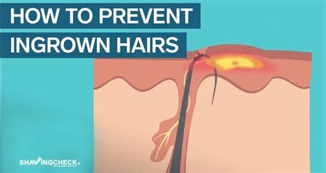 Best shave technique to prevent ingrown hairs?