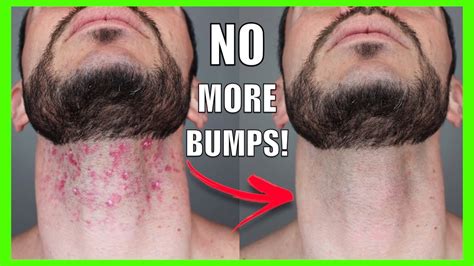 Best way to stop razor bumps on neck?