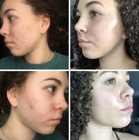 6 Tips to get flawless skin