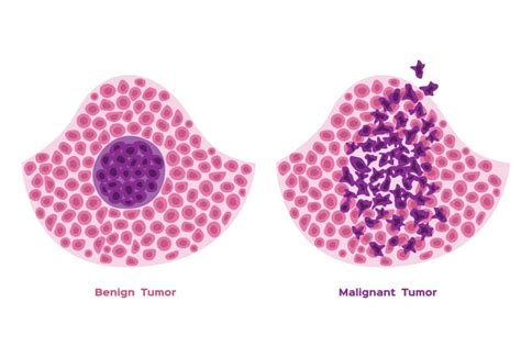 What is benign prostatic hyperplasia (BPH), and what are its common symptoms?