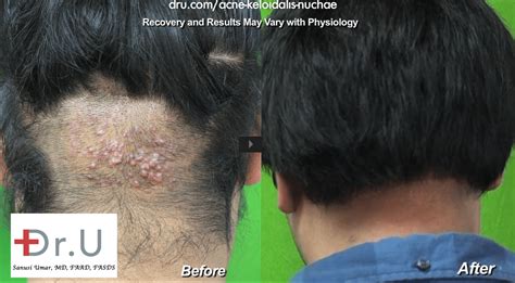 Video: Dr. U AKN Back of Neck Razor Bumps Removal Surgery Results