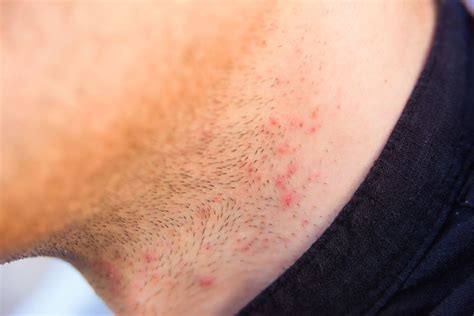 Optimal shave: How to eliminate razor burn & ingrowns for a professional edge?