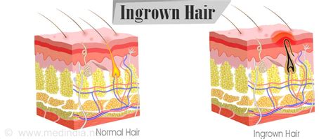 Ingrown Hair - Causes, Symptoms, Complications, Diagnosis, Treatment ...