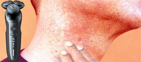 Electric Razor Burn: Why It Happens and How to Get Rid of It?