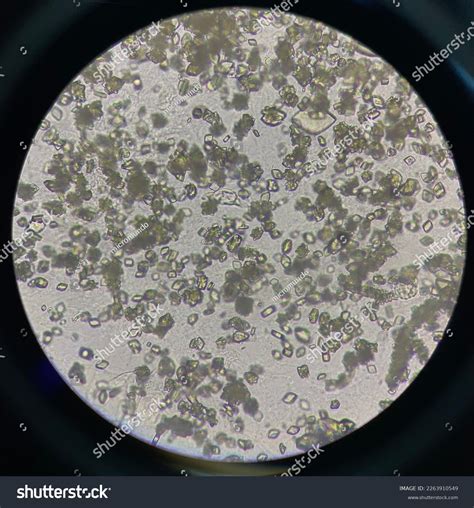 Uric Acid Crystals Urine Sediment Microscope Stock Photo 2263910549 | Shutterstock