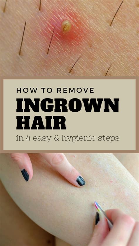 How To Remove Ingrown Hair In 4 Easy And Hygienic Steps #ingrown-hair # ...