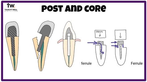 Post and Core | ENDODONTICS - YouTube